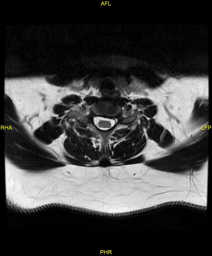 Cervical disc protrusion (Radiopaedia 87147-103415 Axial T2 55).jpg
