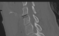 Cervical disc replacement (Radiopaedia 37383-39205 Sagittal bone window 46).png