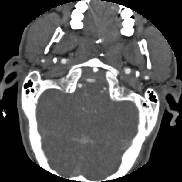 File:Cervical spine fractures with vertebral artery dissection (Radiopaedia 32135-33078 D 71).jpg