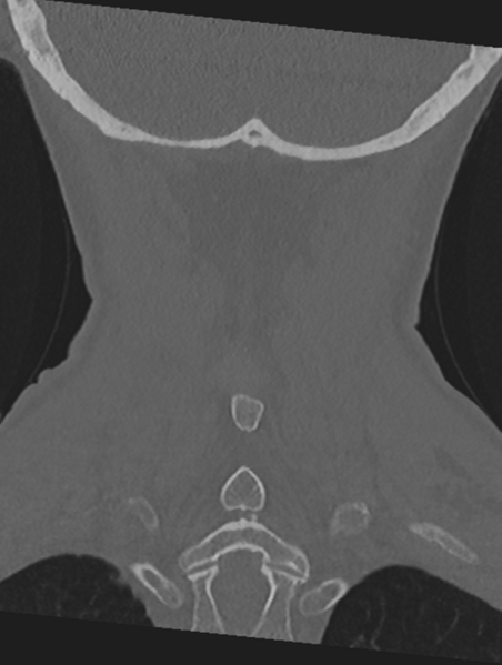 File:Cervical spondylolysis (Radiopaedia 49616-54811 Coronal bone window 49).png