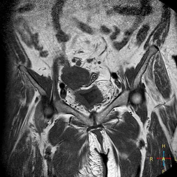 File:Cervical stump squamous cell carcinoma (Radiopaedia 48049-52858 Coronal T1 3).jpg