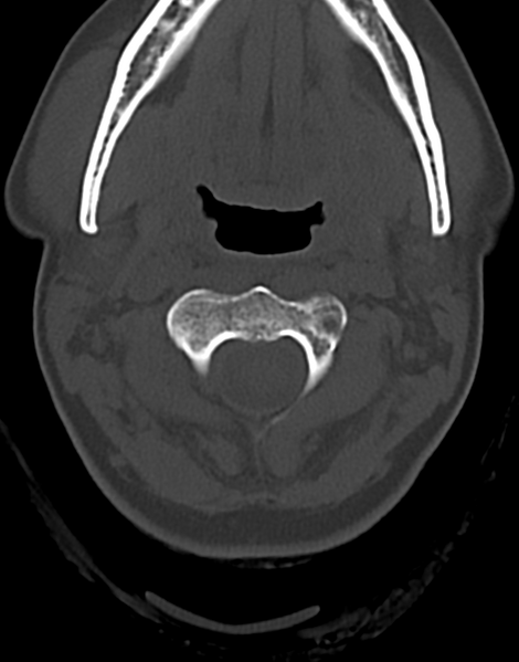 File:Cervical tuberculous spondylitis (Radiopaedia 39149-41365 Axial bone window 16).png