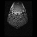 Cervical vertebrae metastasis (Radiopaedia 78814-91667 Axial T1 C+ fat sat 1).png