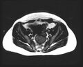 Cesarean section scar endometrioma (Radiopaedia 56569-63297 Axial T1 10).jpg