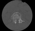 Chance fracture (Radiopaedia 11293-11657 Axial bone window 1).jpg