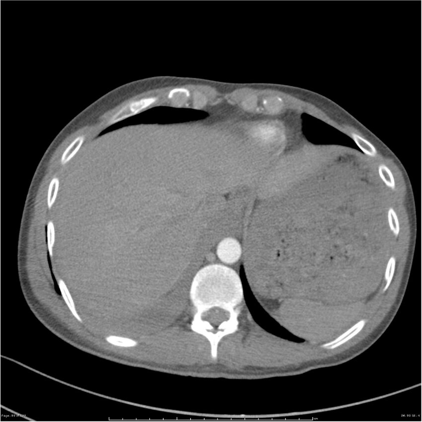 Chest and abdomen multi-trauma (Radiopaedia 26294-26425 A 89).jpg