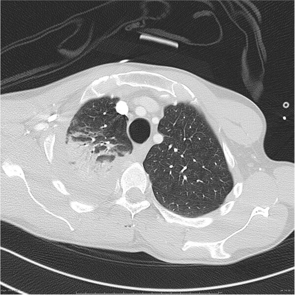File:Chest and abdomen multi-trauma (Radiopaedia 26294-26425 lung window 29).jpg