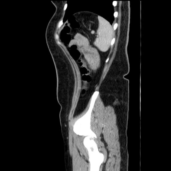 File:Choledocholithiasis on CT and MRI (Radiopaedia 24825-25087 D 54).jpg