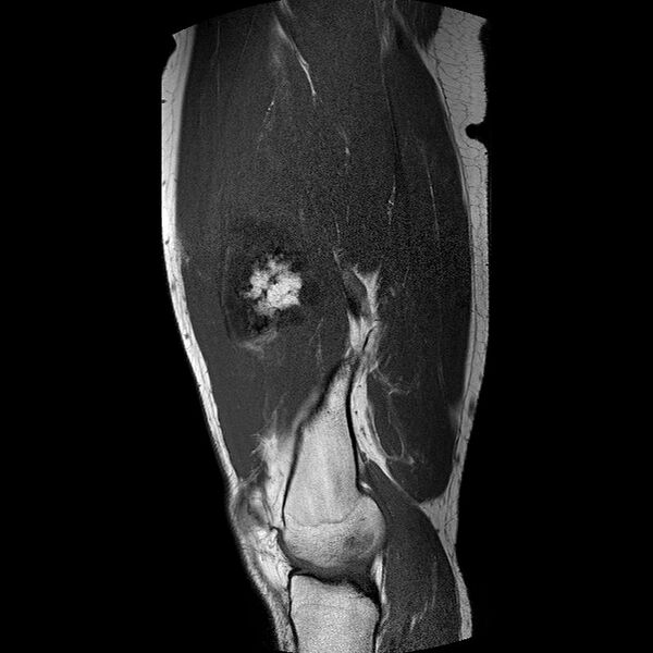 File:Chondrosarcoma arising from exostosis (Radiopaedia 59996-67686 Sagittal T1 TSE 7).jpg