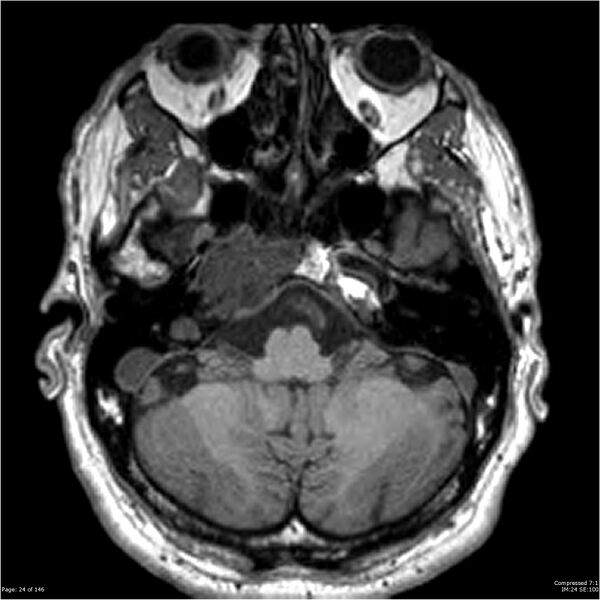 File:Chondrosarcoma of skull base- grade II (Radiopaedia 40948-43654 Axial T1 24).jpg