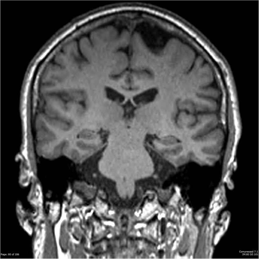 Chondrosarcoma of skull base- grade II (Radiopaedia 40948-43654 Coronal T1 1).jpg