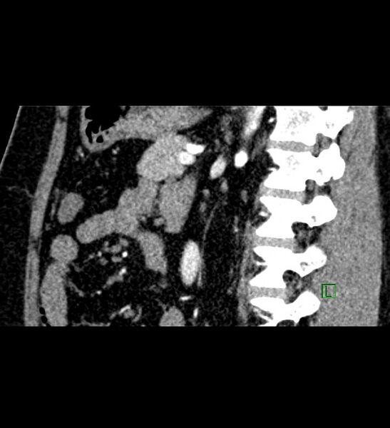 File:Chromophobe renal cell carcinoma (Radiopaedia 84286-99573 F 71).jpg