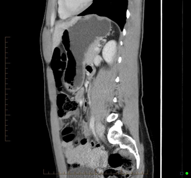 File:Chronic abscess due to "dropped" appendicoliths following appendectomy for perforated appendix (Radiopaedia 58805-66344 D 22).jpg