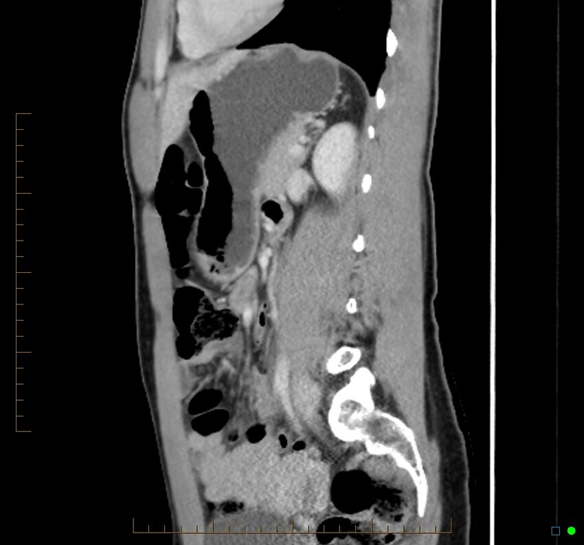 Chronic abscess due to "dropped" appendicoliths following appendectomy for perforated appendix (Radiopaedia 58805-66344 D 22).jpg