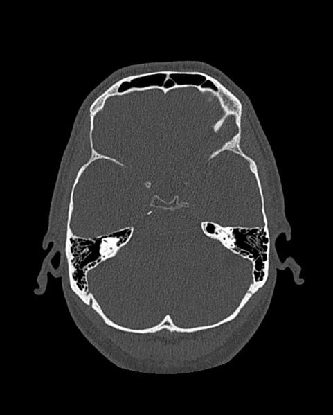 File:Chronic maxillary sinusitis caused by a foreign body (Radiopaedia 58521-65676 Axial bone window 270).jpg