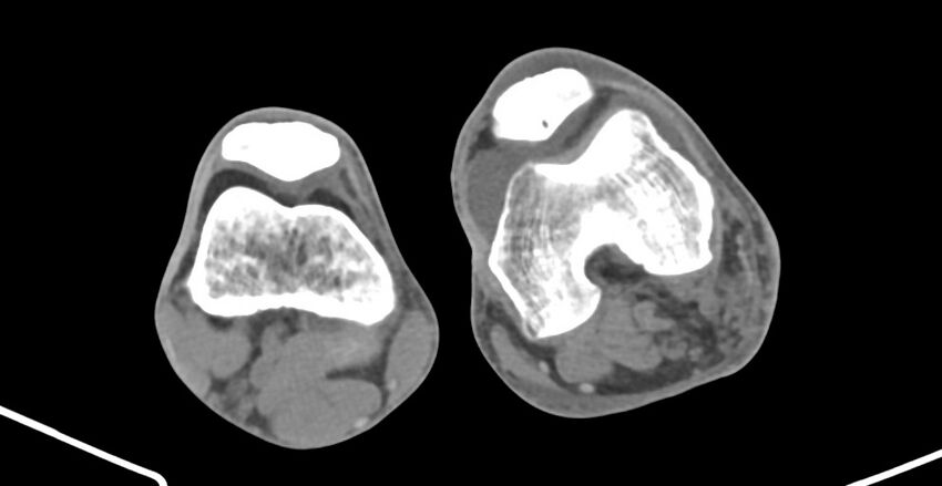 Chronic osteomyelitis (with sequestrum) (Radiopaedia 74813-85822 D 182).jpg