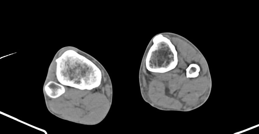 Chronic osteomyelitis (with sequestrum) (Radiopaedia 74813-85822 D 207).jpg
