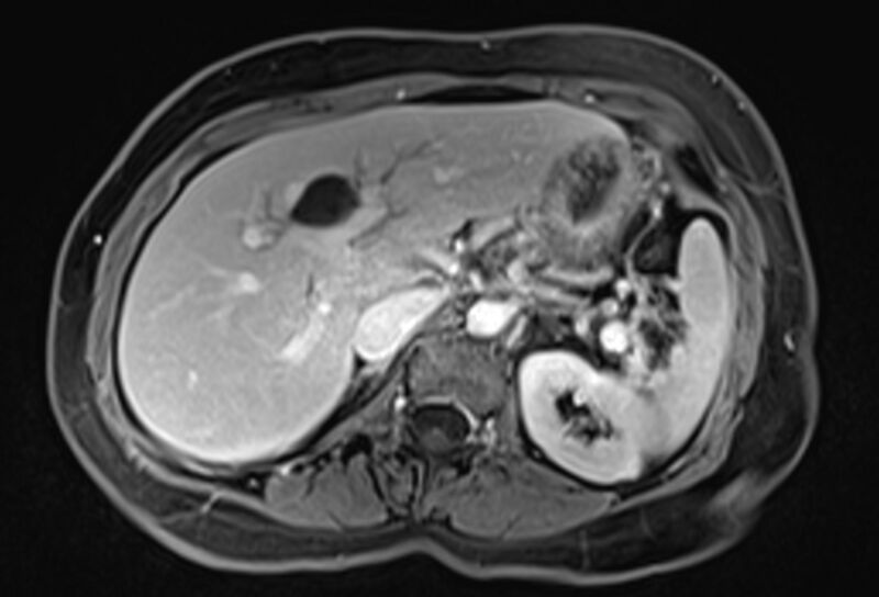 File:Chronic pancreatitis - pancreatic duct calculi (Radiopaedia 71818-82250 Axial T1 C+ fat sat 21).jpg