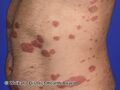 Chronic plaque psoriasis (DermNet NZ psoriasis-flank).jpg