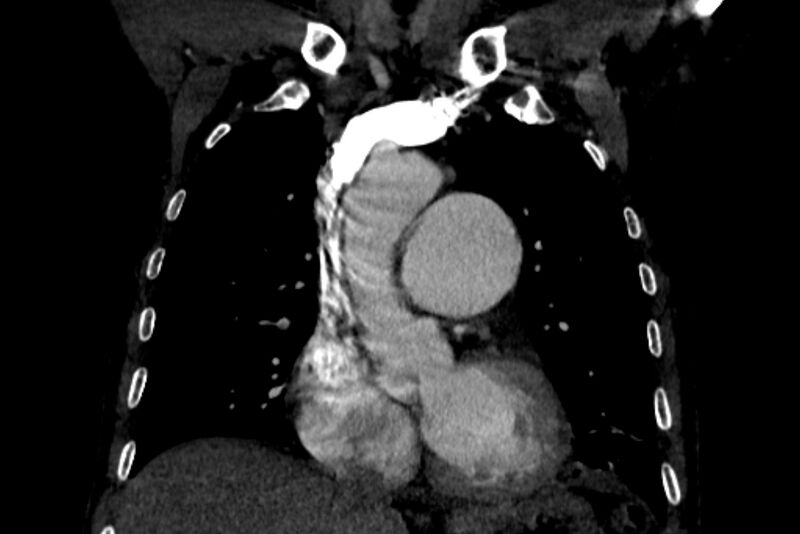 File:Chronic pulmonary embolism with bubbly consolidation (Radiopaedia 91248-108850 B 55).jpg