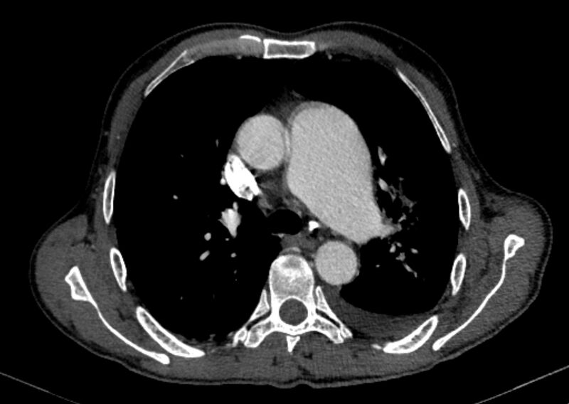 File:Chronic pulmonary embolism with bubbly consolidation (Radiopaedia 91248-108850 C+ arterial phase 54).jpg