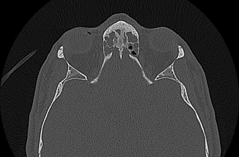 File:Chronic rhinosinusitis (Radiopaedia 65079-74075 Axial bone window 62).jpg