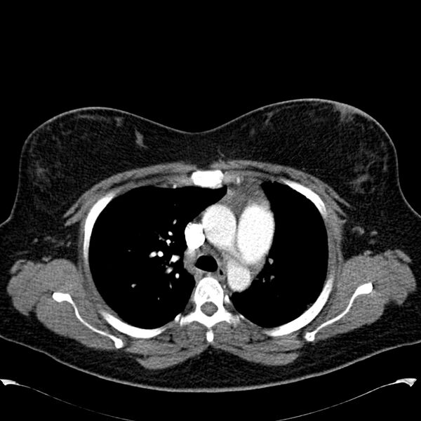 File:Chronic thromboembolic pulmonary hypertension (CTEPH) (Radiopaedia 74597-85531 Axial C+ CTPA 18).jpg
