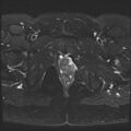 Class II Mullerian duct anomaly- unicornuate uterus with rudimentary horn and non-communicating cavity (Radiopaedia 39441-41755 Axial T2 fat sat 26).jpg