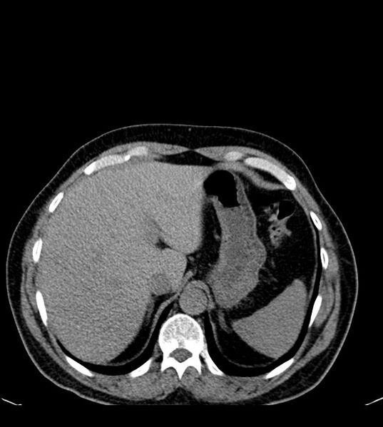 File:Clear cell renal cell carcinoma (Radiopaedia 85006-100539 Axial non-contrast 21).jpg