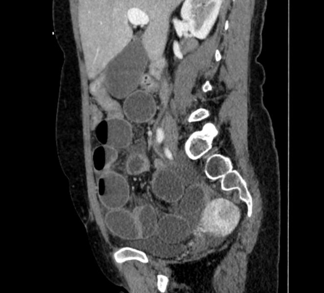 File:Closed loop small bowel obstruction (Radiopaedia 71211-81508 C 51).jpg