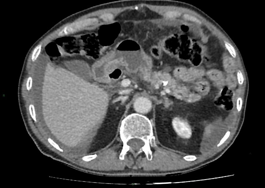 Closed loop small bowel obstruction with ischemia (Radiopaedia 84180-99456 A 30).jpg