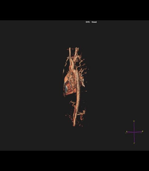 File:Coarctation of the aorta (Radiopaedia 43373-46729 3D reconstruction 11).jpg