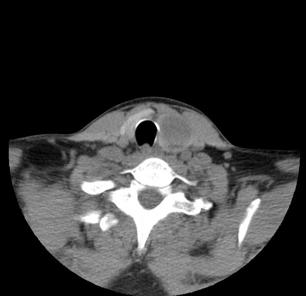 File:Colloid cyst of thyroid (Radiopaedia 22897-22923 Axial non-contrast 42).jpg