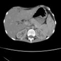 Colocolic fistula - Crohn disease (Radiopaedia 57063-63955 A 17).jpg