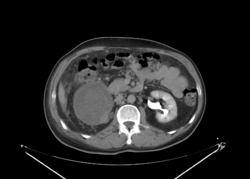 File:Colon cancer mimicking renal cell carcinoma (Radiopaedia 28986-29335 Axial C+ delayed 31).jpg