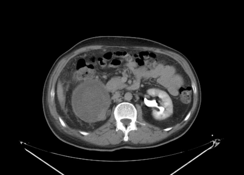 Colon cancer mimicking renal cell carcinoma (Radiopaedia 28986-29335 Axial C+ delayed 31).jpg