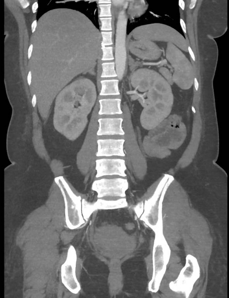 File:Colonic pseudo-obstruction (Radiopaedia 79752-92980 B 41).png