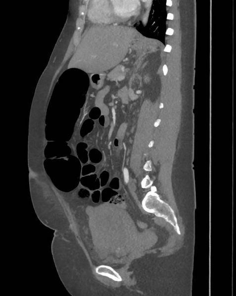 File:Colonic pseudo-obstruction (Radiopaedia 79752-92980 C 45).png