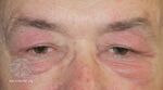 Dermatomyositis of eyelids (DermNet NZ dermatomyositis-eyelids-6).jpg