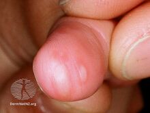 Hand foot and mouth disease (DermNet NZ viral-hfm12).jpg