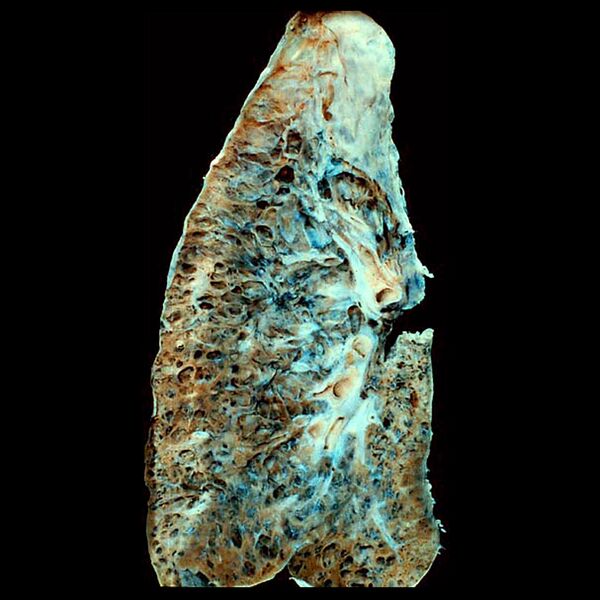 File:Honeycomb lung (gross pathology) (Radiopaedia 8621).jpg