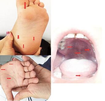 Lesions on hands and soles of feet, and blisters in oral cavity of individual who presented with hand, foot and mouth disease