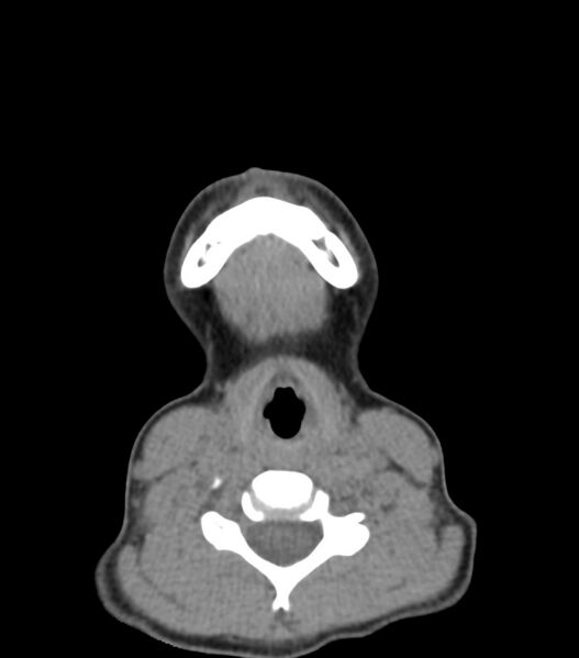 File:Nasoorbitoethmoid fracture (Radiopaedia 90044-107205 Axial non-contrast 31).jpg