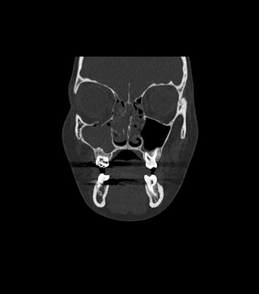 File:Nasoorbitoethmoid fracture (Radiopaedia 90044-107205 Coronal bone window 46).jpg