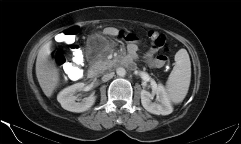File:Necrotizing pancreatitis (Radiopaedia 20595-20495 A 17).jpg
