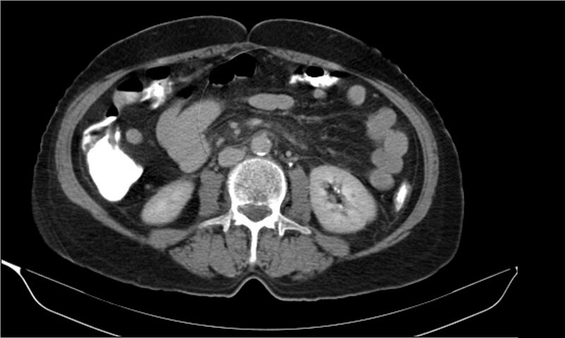 File:Necrotizing pancreatitis (Radiopaedia 20595-20495 Axial C+ delayed 23).jpg