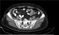 Necrotizing pancreatitis (Radiopaedia 20595-20495 Axial C+ delayed 35).jpg