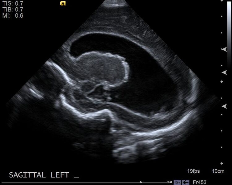 File:Neonatal intracranial hemorrhage - grade 3 (Radiopaedia 27279-27455 Longitudinal 15).jpg