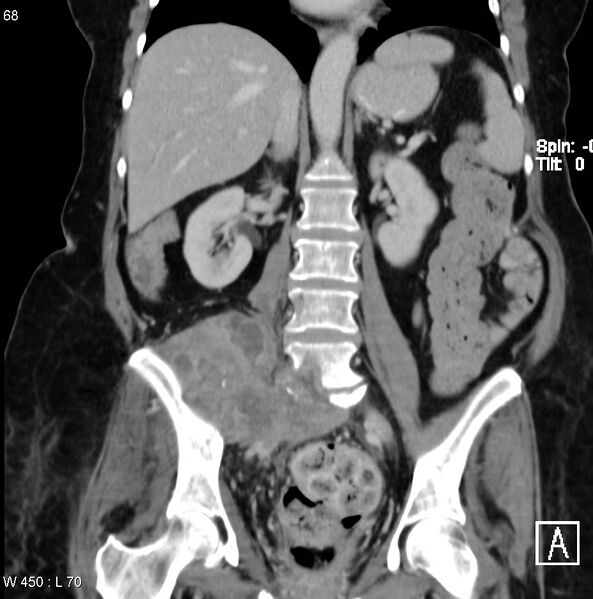 File:Nerve sheath tumor - malignant - sacrum (Radiopaedia 5219-6987 B 7).jpg