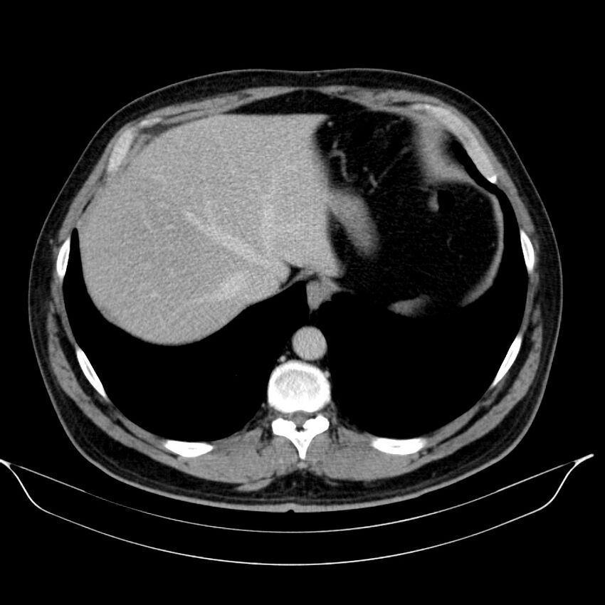 Neuroendocrine tumor of head of pancreas (Radiopaedia 57538-64502 D 14).jpg